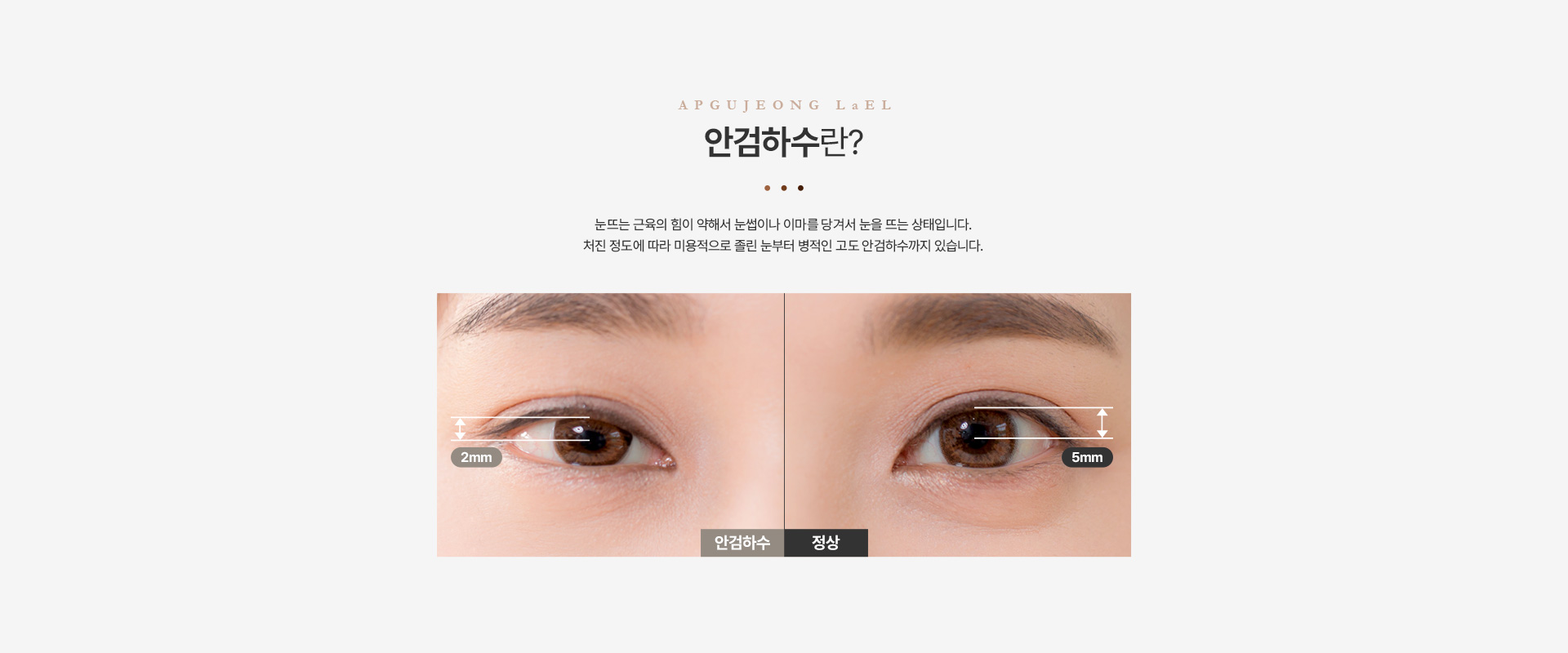 눈매교정 안검하수란