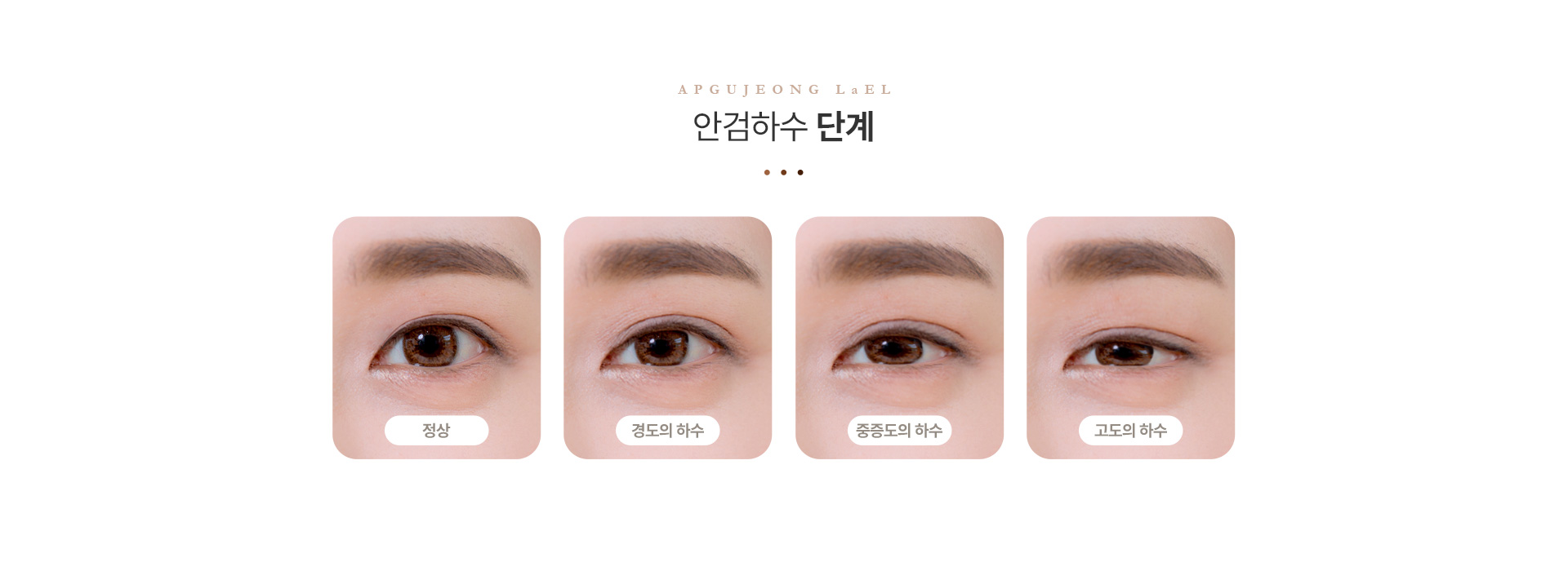 눈매교정 안검하수단계