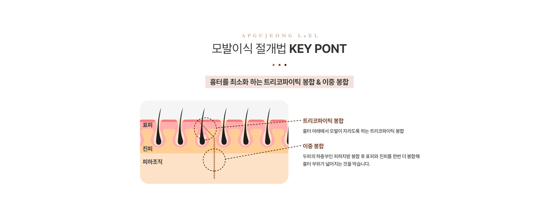 모발이식 절개법키포인트