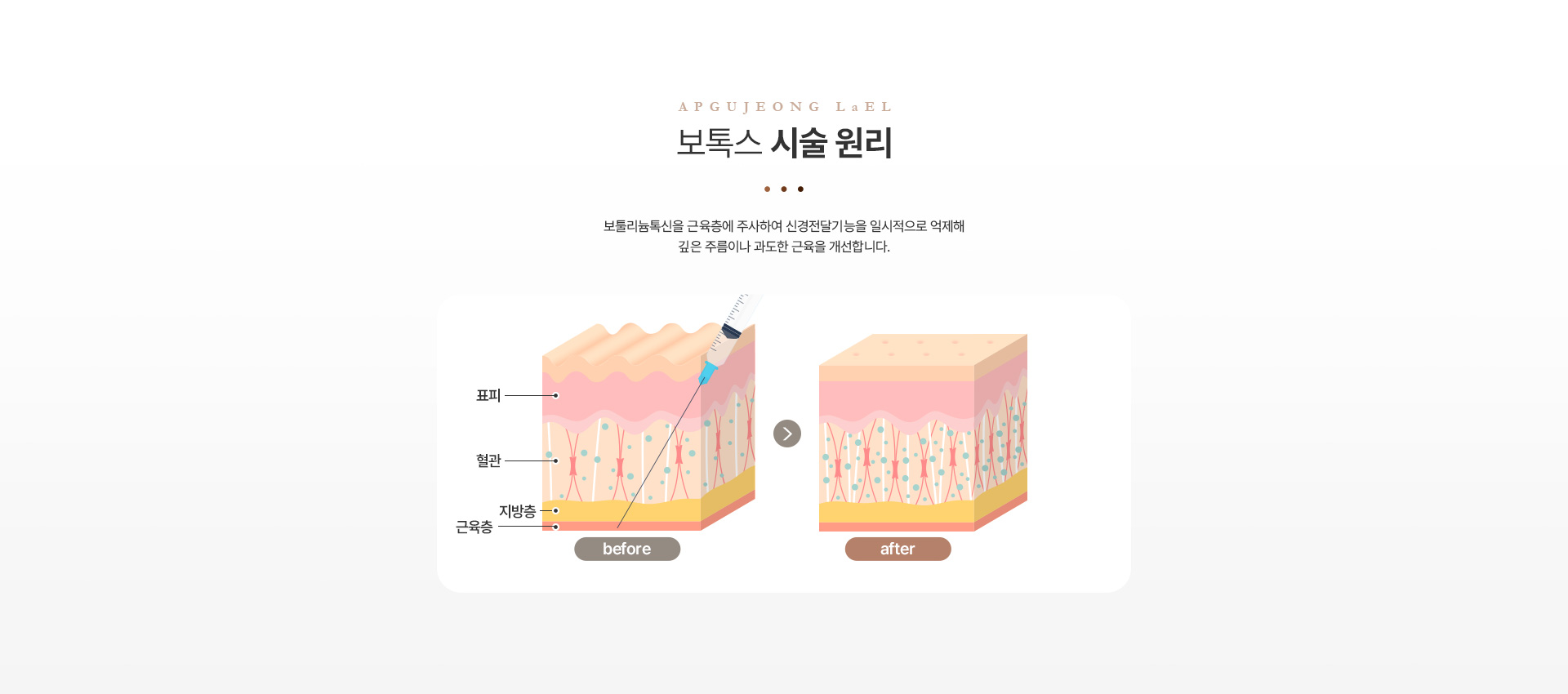 보톡스 시술원리