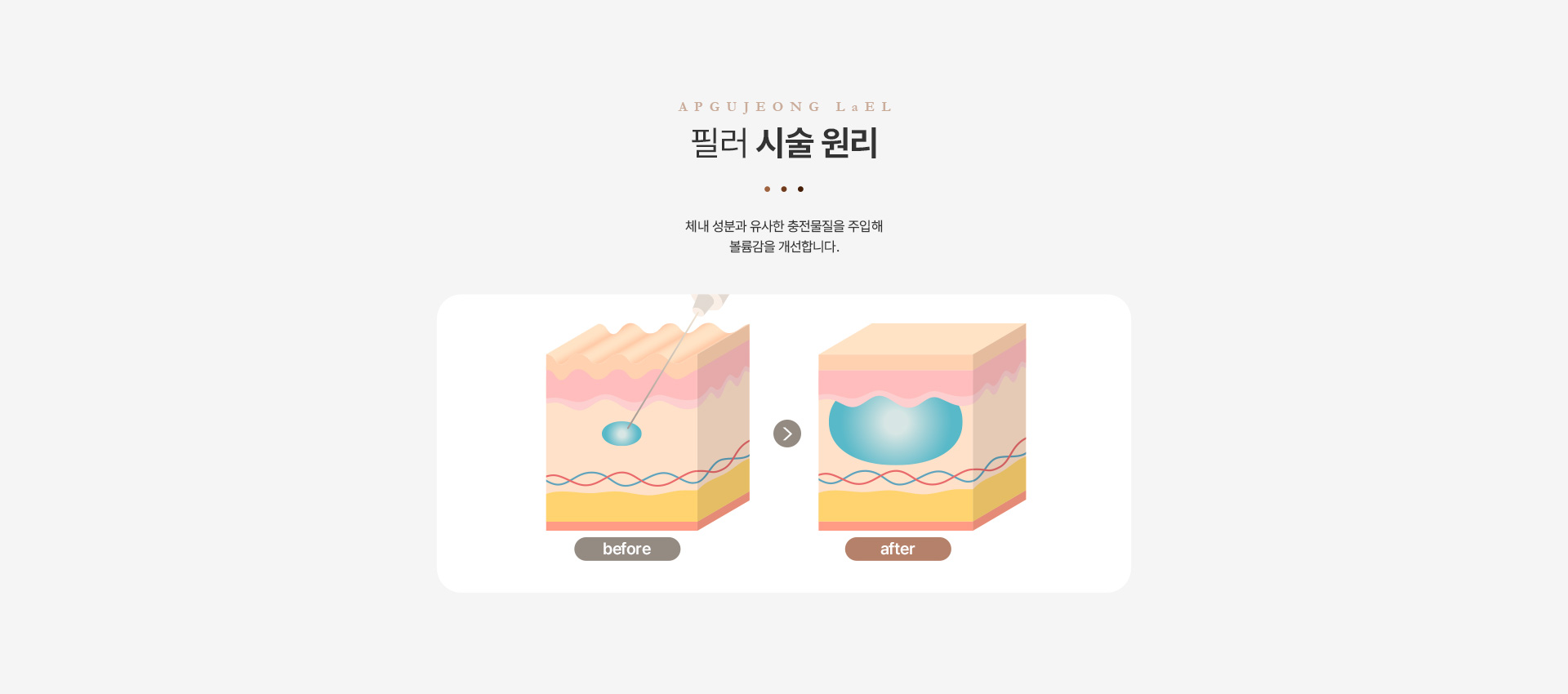 필러 시술원리