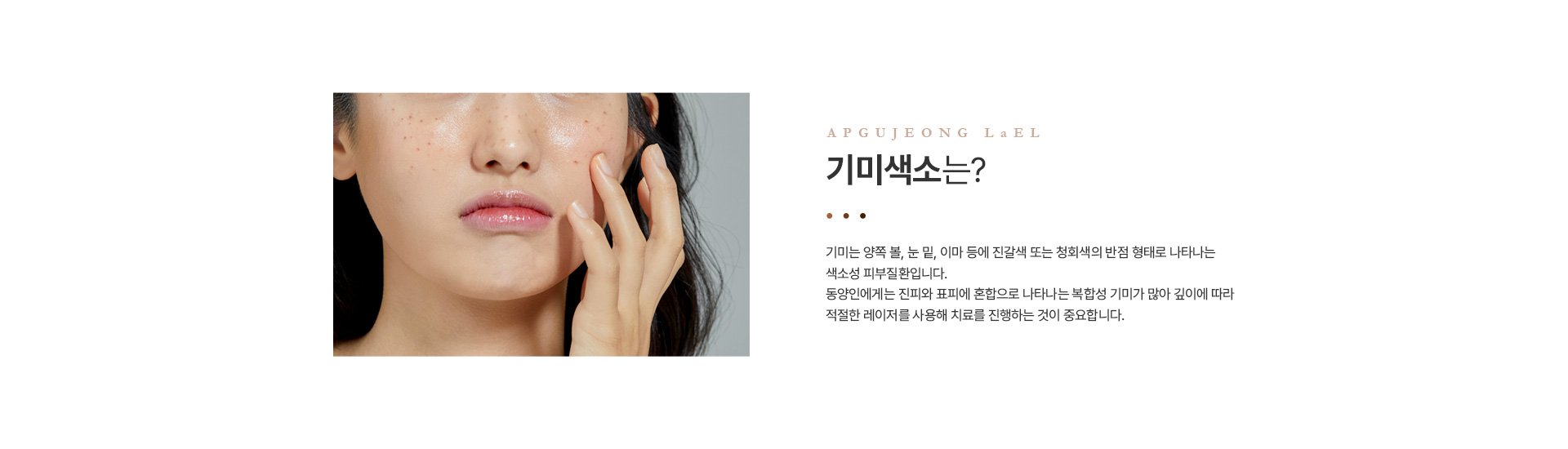 기미색소 정의